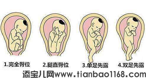 西安哪个医院试管婴儿比较成功：如何纠正胎儿的臀位