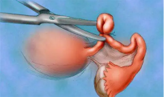 淮安借卵试管生子：一些医生建议妇女在做试管婴儿前先把输卵管钳住，而在钳住输卵管的情况下做试管婴儿还有这些好处