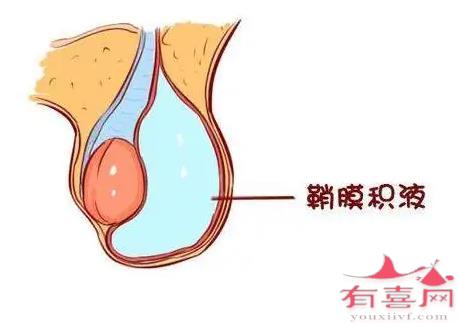 曲靖54岁借腹生子：睾丸积液可以自行消失吗？